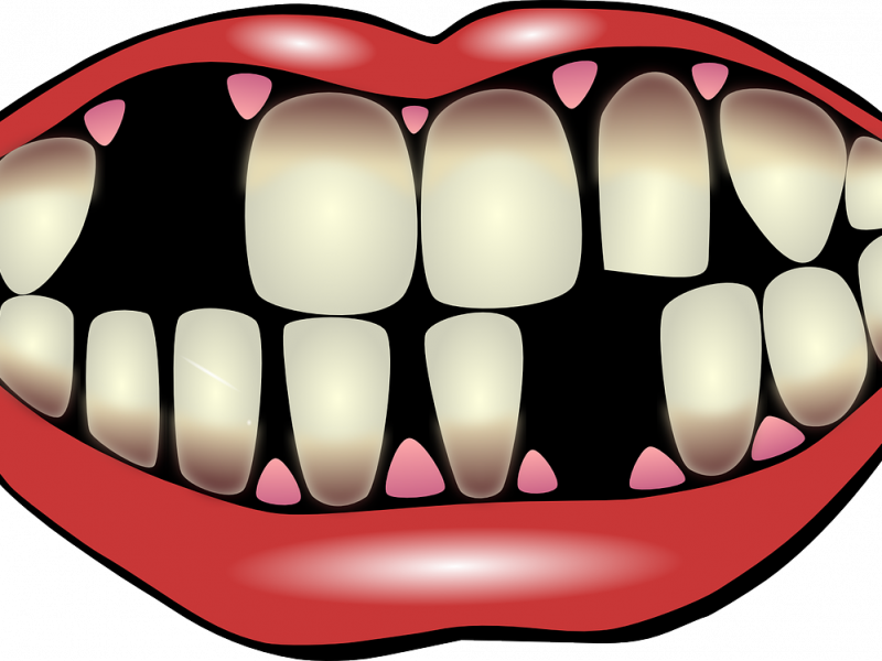 Splinting of mobile and loose teeth