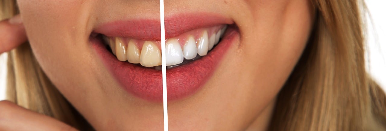 How to get rid of yellow teeth