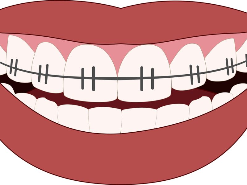 Demerits of incomplete orthodontic treatment