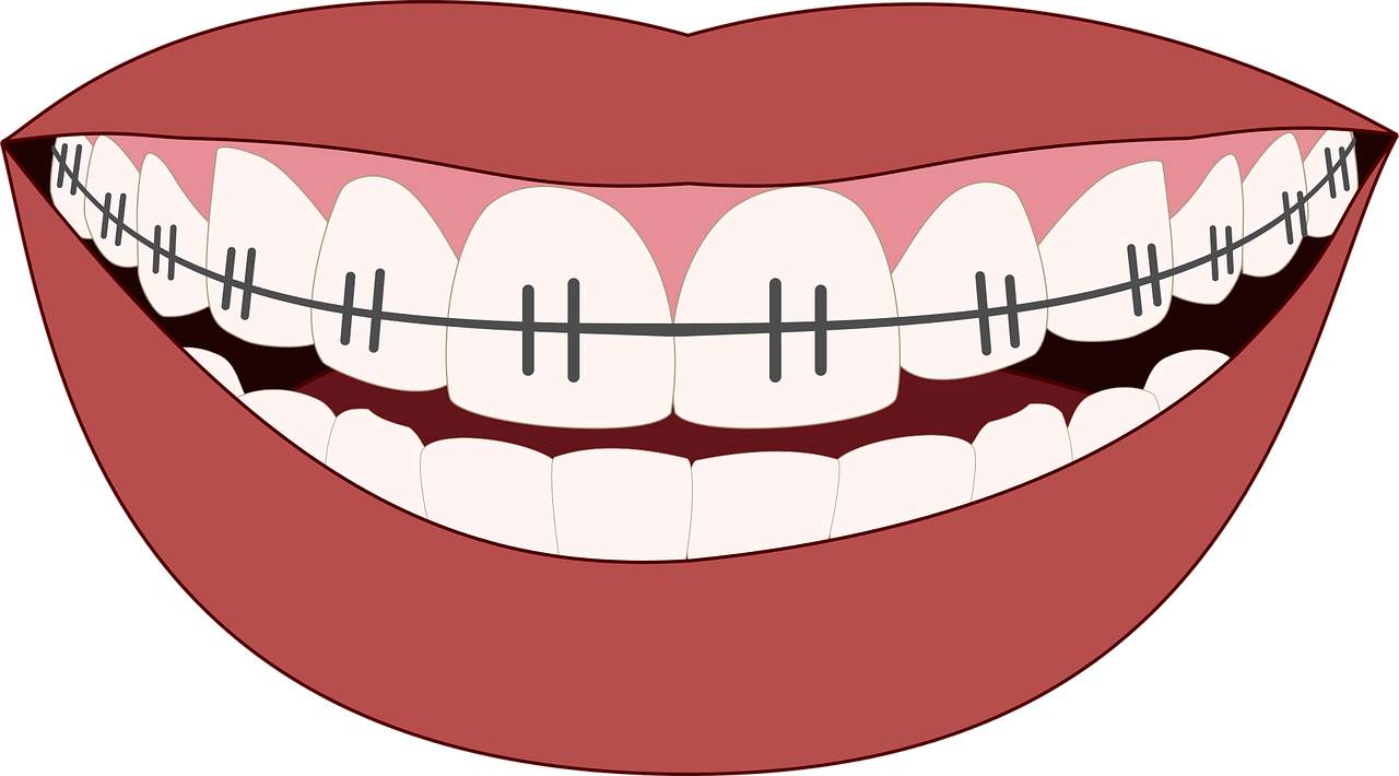 Demerits of incomplete orthodontic treatment
