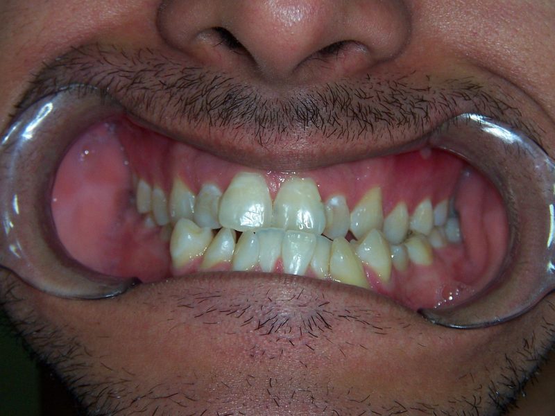 Bruxism or teeth clenching