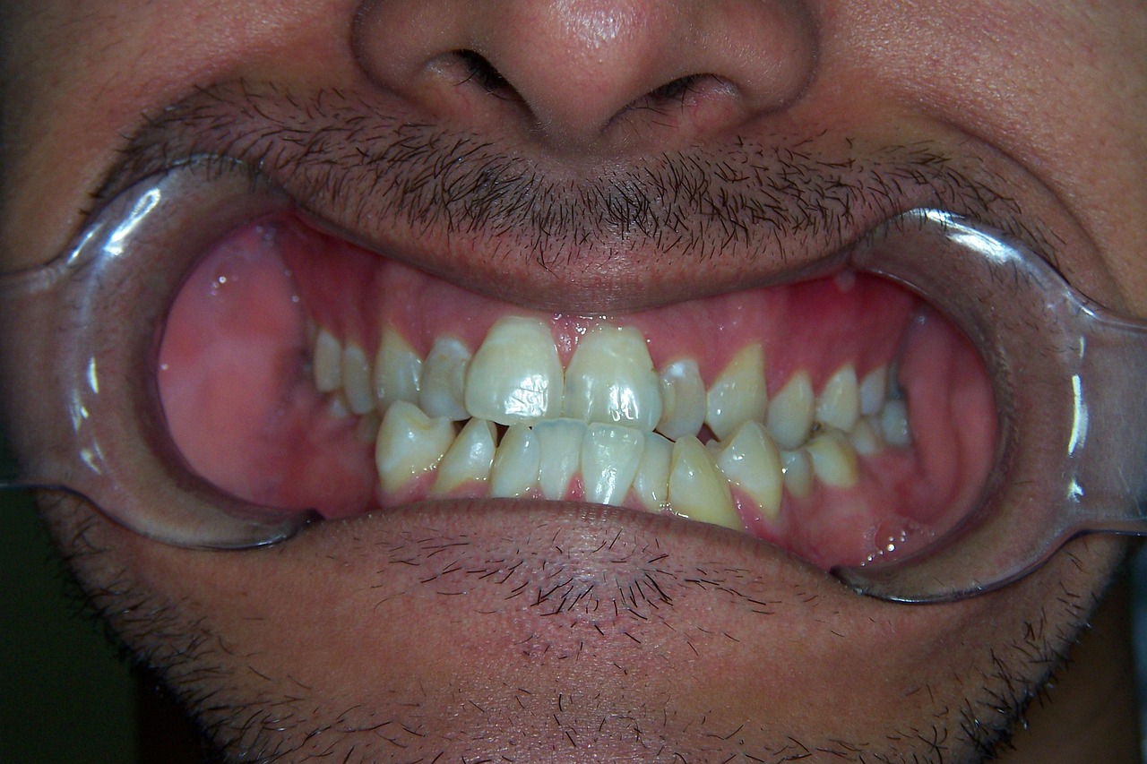 Bruxism or teeth clenching