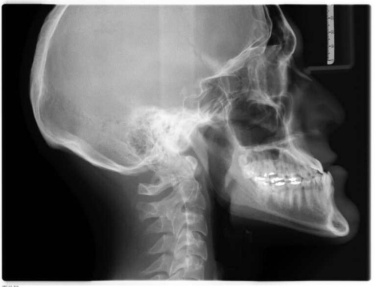 Jaw clicking (TMJ popping) causes and management